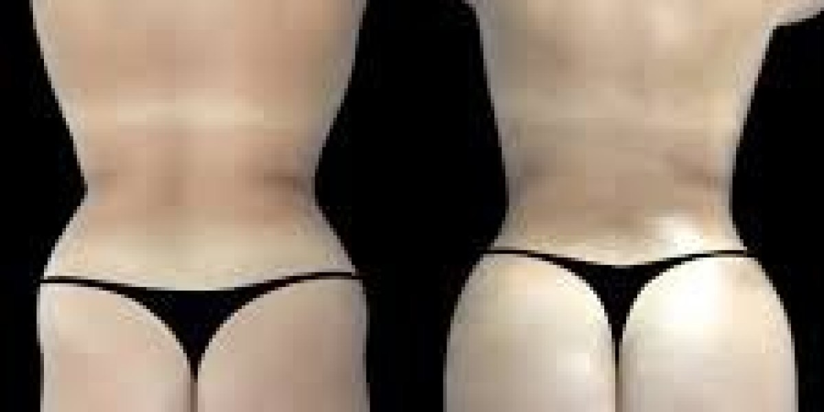 What to Know About Compression Garments from the Best Butt fat transfer Surgeons in dubai