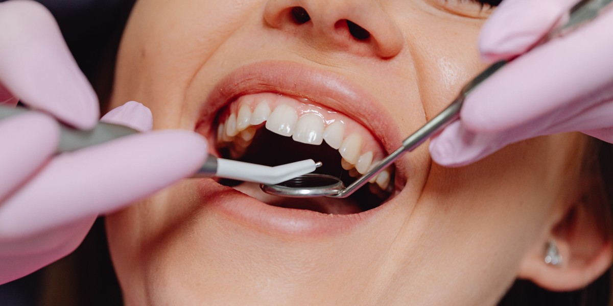 Dental Implants North London & Composite Bonding Near Me: Discover Your Perfect Smile at Iconic Smiles