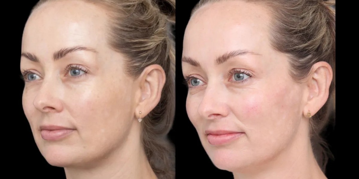 Cheek Fillers Facial Enhancement: Best Aesthetic Clinic in Dubai Guide