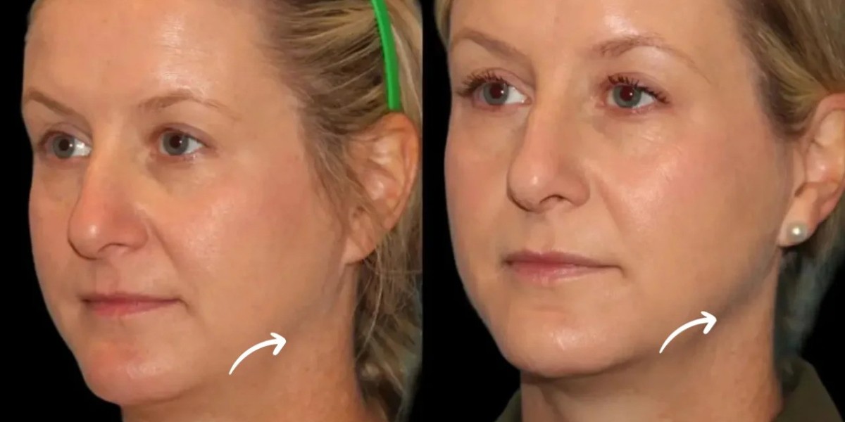 Best Aesthetic Clinic in Dubai: Sculptra Myths and Medical Facts