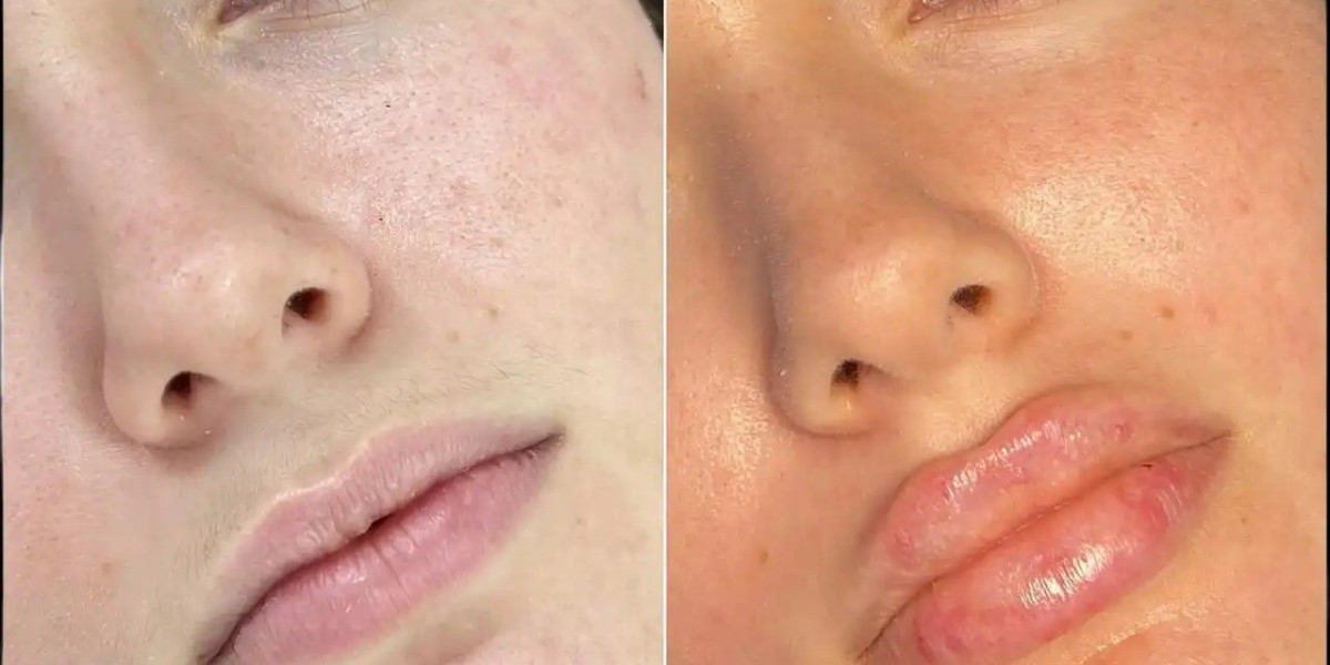 What Makes a Best Aesthetic Clinic in Dubai Suitable for Fillers Treatment?