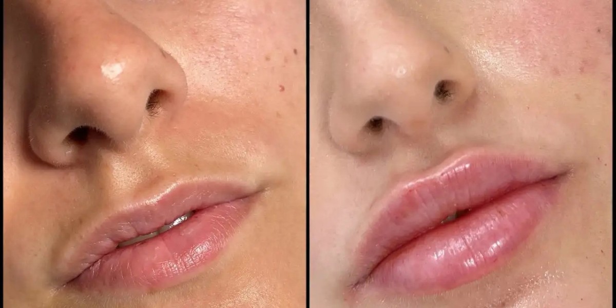 Dermal Fillers for Volume Loss Best Aesthetic Clinic in Dubai Treatment