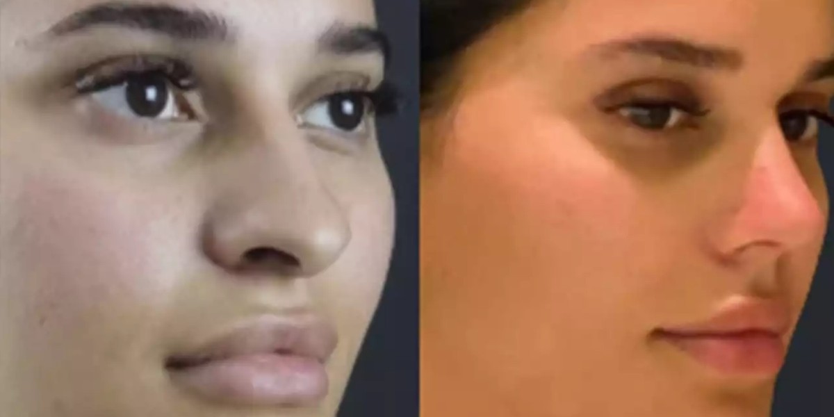 How Do Surgeons Evaluate Patients Before Rhinoplasty in Dubai?