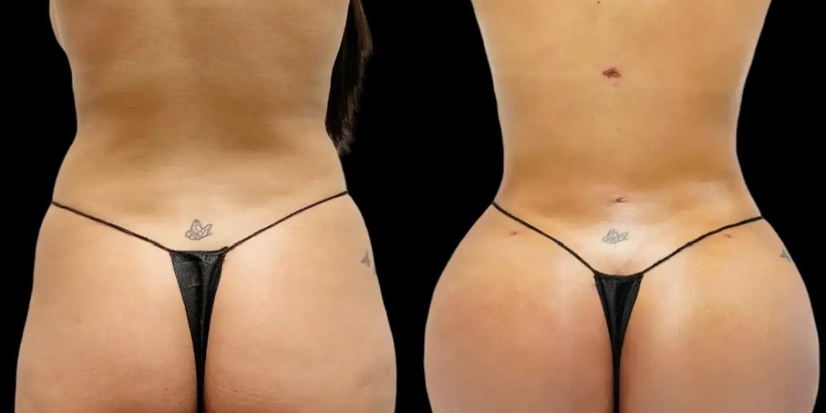 What Influences Long-Term Results with the Best fat transfer Surgeons in dubai