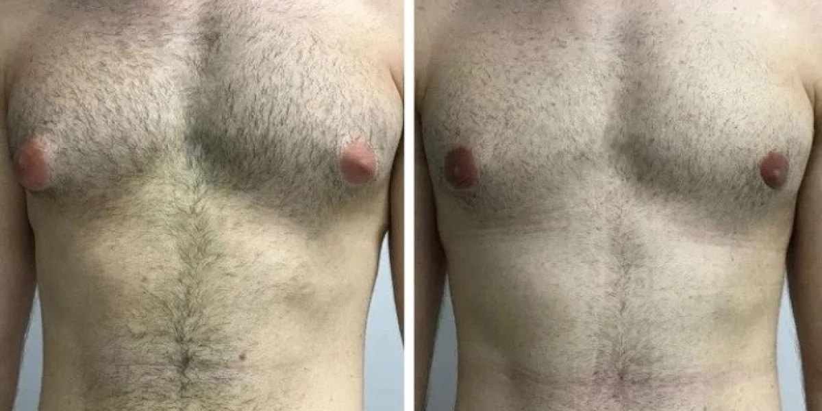 How Gynecomastia Surgery in dubai Assesses Skin Retraction Patterns